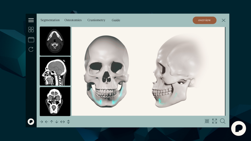 JAWContour® 3D video showing the technology during the surgical planning in a jaw and chin facial bone surgery